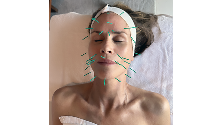 Inside the Acupuncture Facial That’s a Total Skin Turnaround